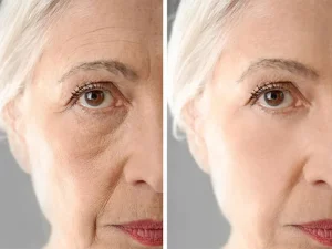 ماندگاری تزریق چربی به صورت