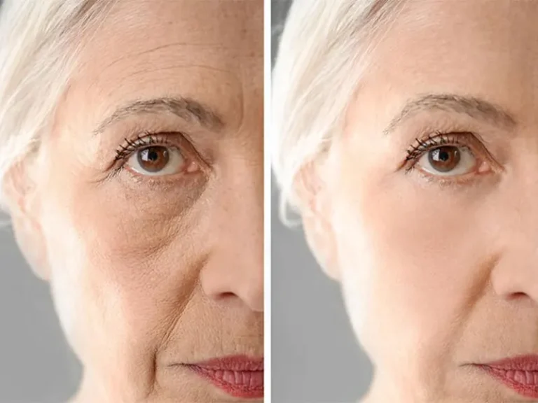 ماندگاری تزریق چربی به صورت