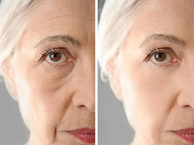 ماندگاری تزریق چربی به صورت